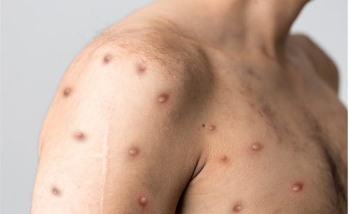 إعلان جدري القردة حالة طوارئ صحية عالمية