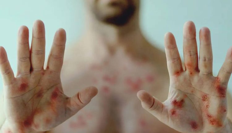 ما يجب أن نعرفه عن جدري القردة وفق منطمة الصحة العالمية
